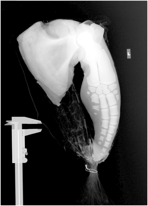 Ein Röntgenbild eines menschlichen Beins mit einem sichtbaren Bruch in der Mitte, wahrscheinlich eine Bänderverletzung, vor einem schwarzen Hintergrund.
